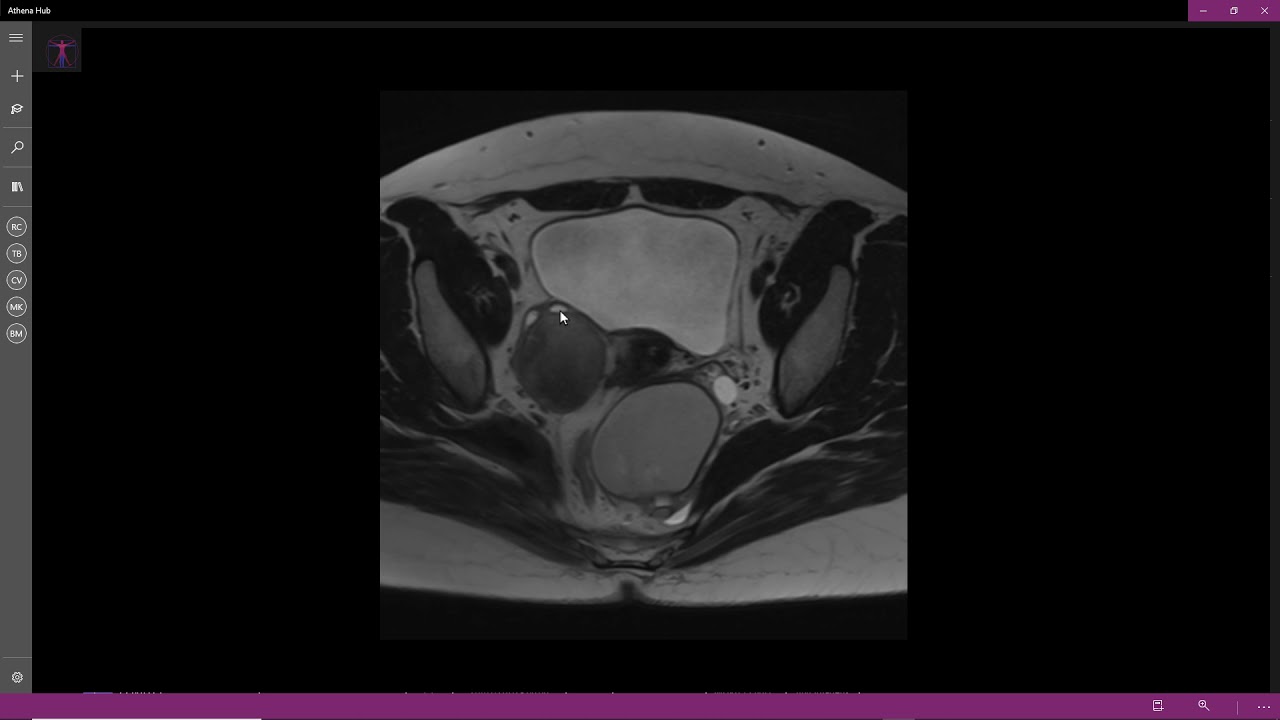 Endometriomas