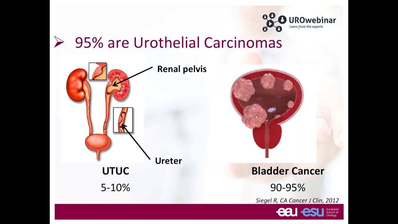 Urowebinar: Update on bladder cancer management what are we doing wrong BY MORGAN ROUPRET