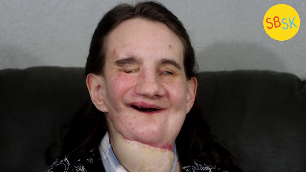 A Blind Mom with a Facial Difference