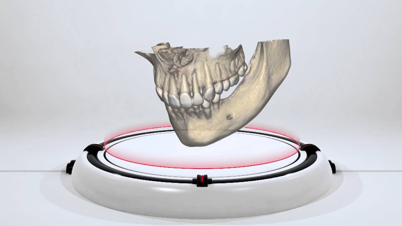Perfect Smile Fogászat - az implantátum és az implantálás