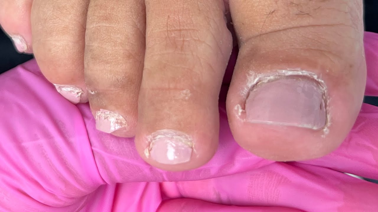 Transformação nas unhas dos pés