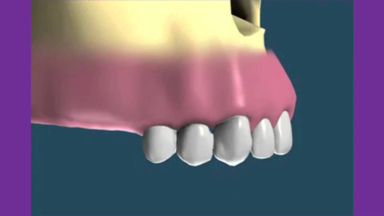 Pr&oacute;tesis mixta implante/diente, efectos de la sobrecarga.