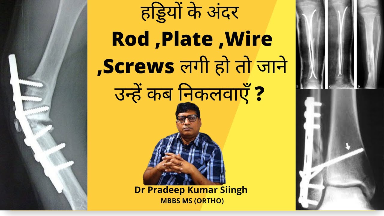 हड्डियों के अंदर Rod ,Plate ,Wire ,Screws लगी हो तो जाने उन्हें कब निकलवाएँ ?/Dr Pradeep Kumar singh
