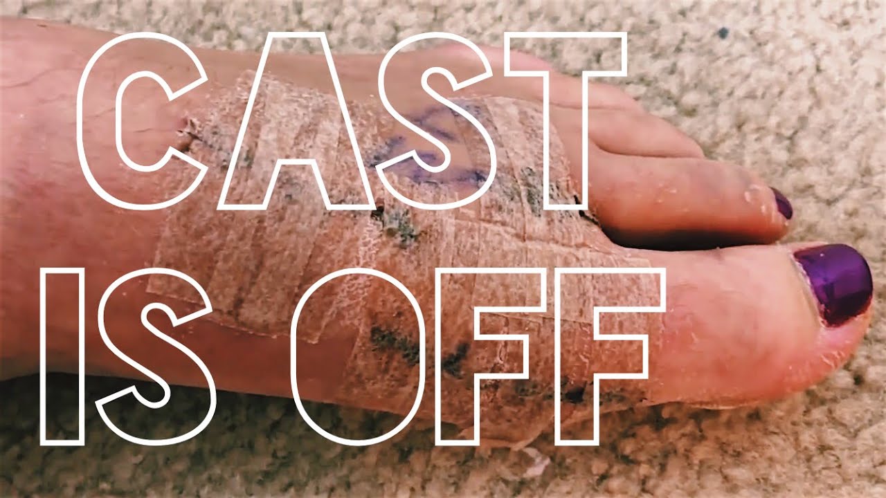 BADLY BRUISED FOOT | Bunion Surgery