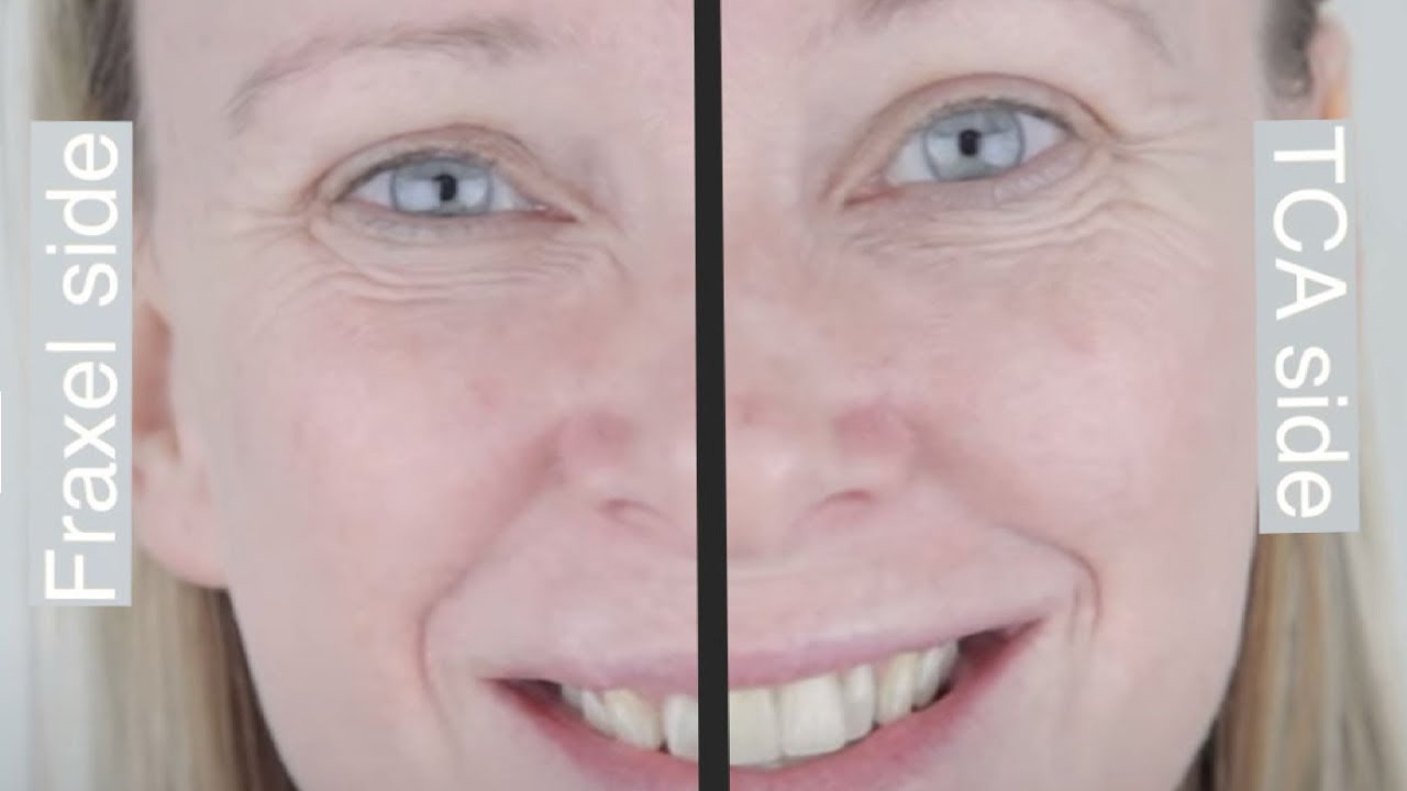 Split face study - Fraxel laser Vs TCA peel