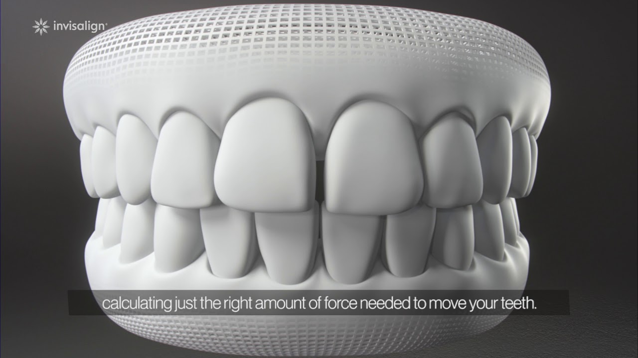 How Does Invisalign Straighten Teeth?