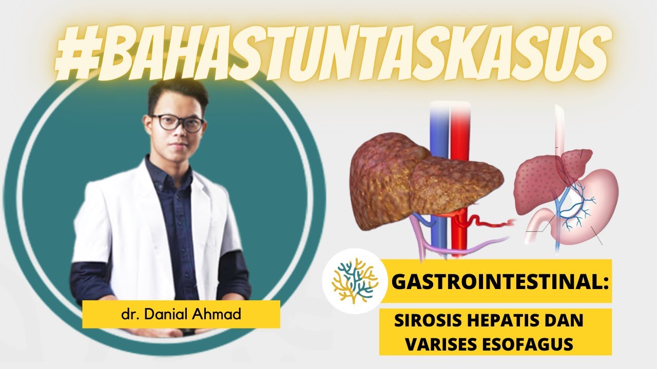 SINAPINTAR #16 | Gastrointestinal : Sirosis Hepatis dan Varises Esofagus