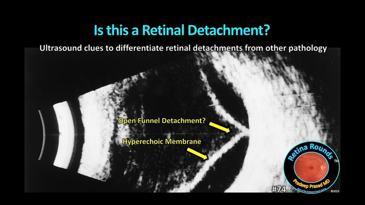 RetinaRounds™ 74: Is this a Retinal Detachment?