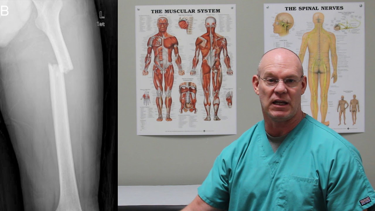 Transverse Femur Fractures | Fracture Friday Episode 40