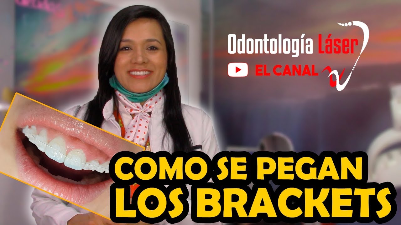 Como se pegan los Brackets - Odontología Láser