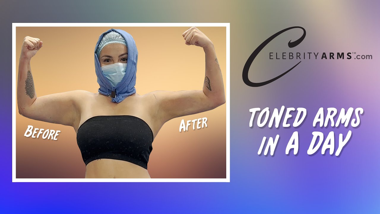 Lipo 360&deg; Arms | Arm Liposuction | Immediate Results | Celebrity Arms&trade; | Expert Dr. Thomas Su
