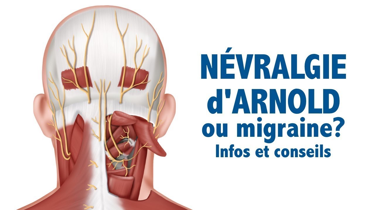 Névralgie d'Arnold ou migraine? Infos et conseils