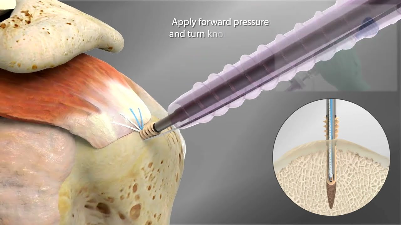Ventix™ Anclaje atornillable sin nudos Zimmer Biomet