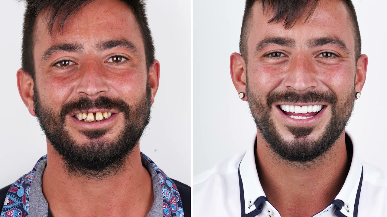 Albert Consiguió su Sonrisa de Hollywood con Dentakay | Hollywood Smile