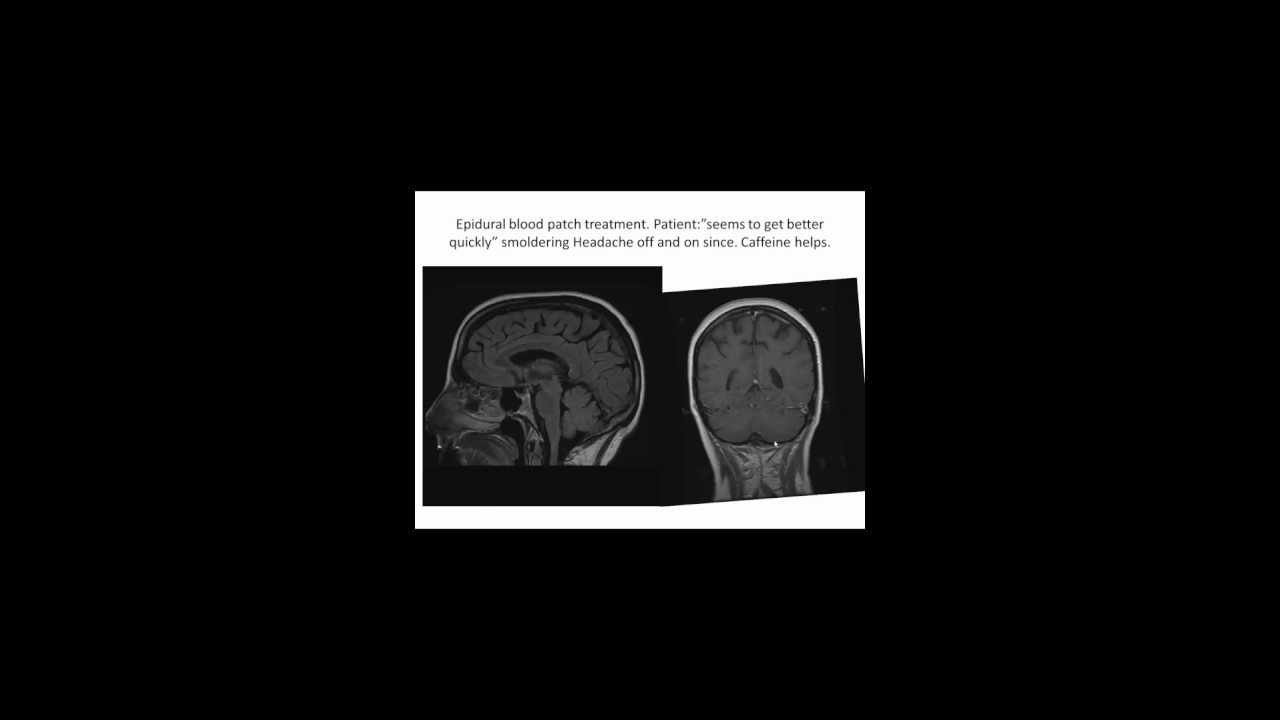 CSF pressure disturbance