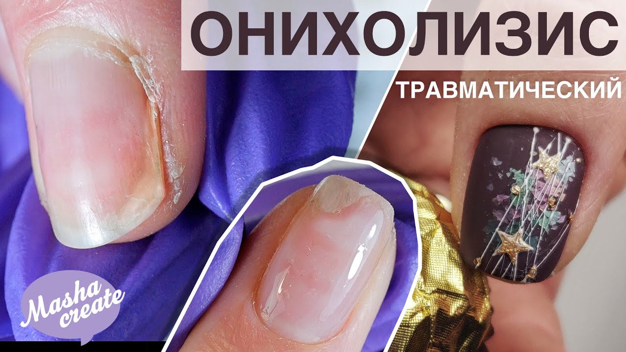 Травматический ОНИХОЛИЗИС: 3 вида. Что делать при отслоении ногтя? Новогодний маникюр 2019-2020