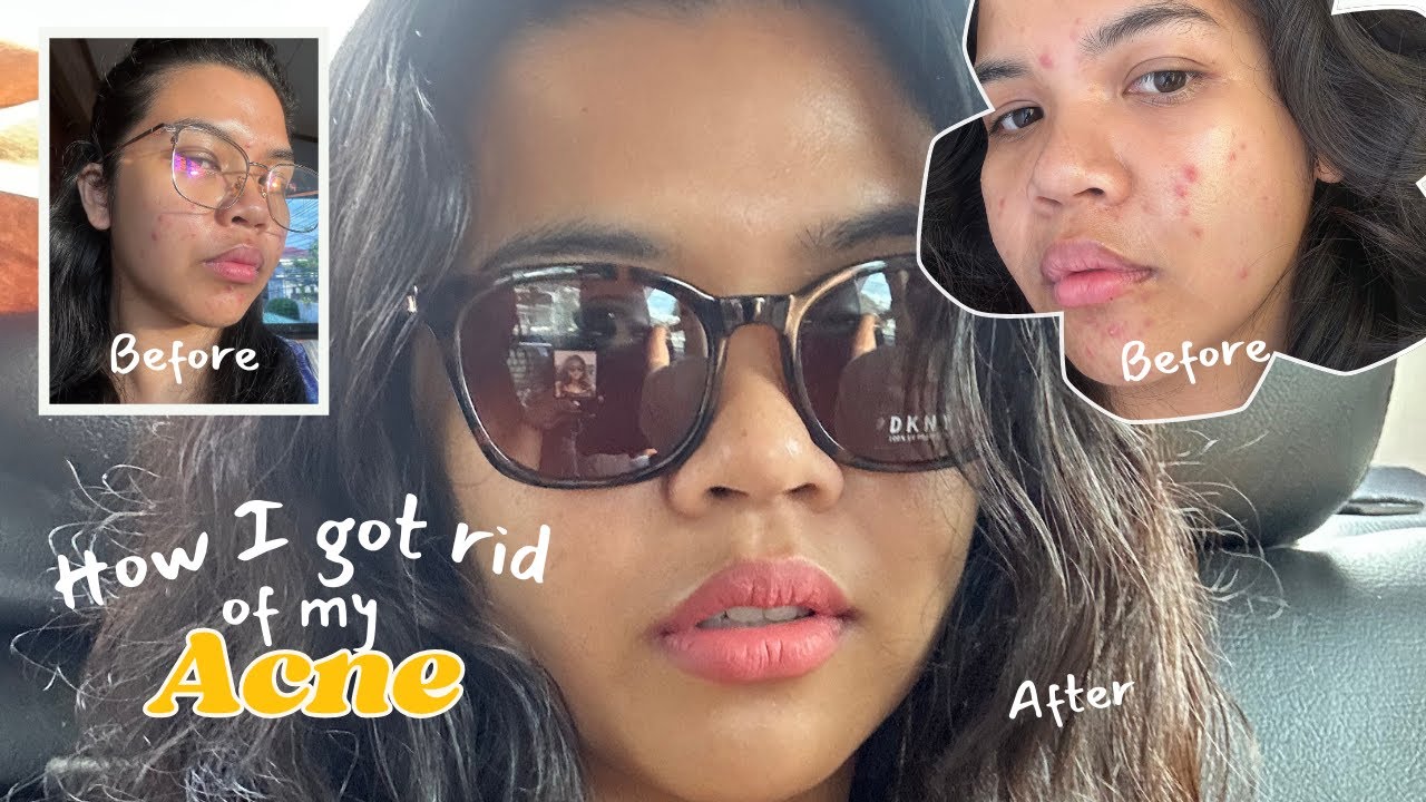 How I got rid of my acne: My Acne Finally Cleared… Here’s What Actually Worked | 2026 Glow Up