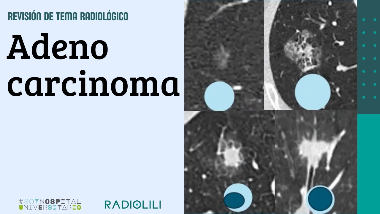 Adenocarcinoma