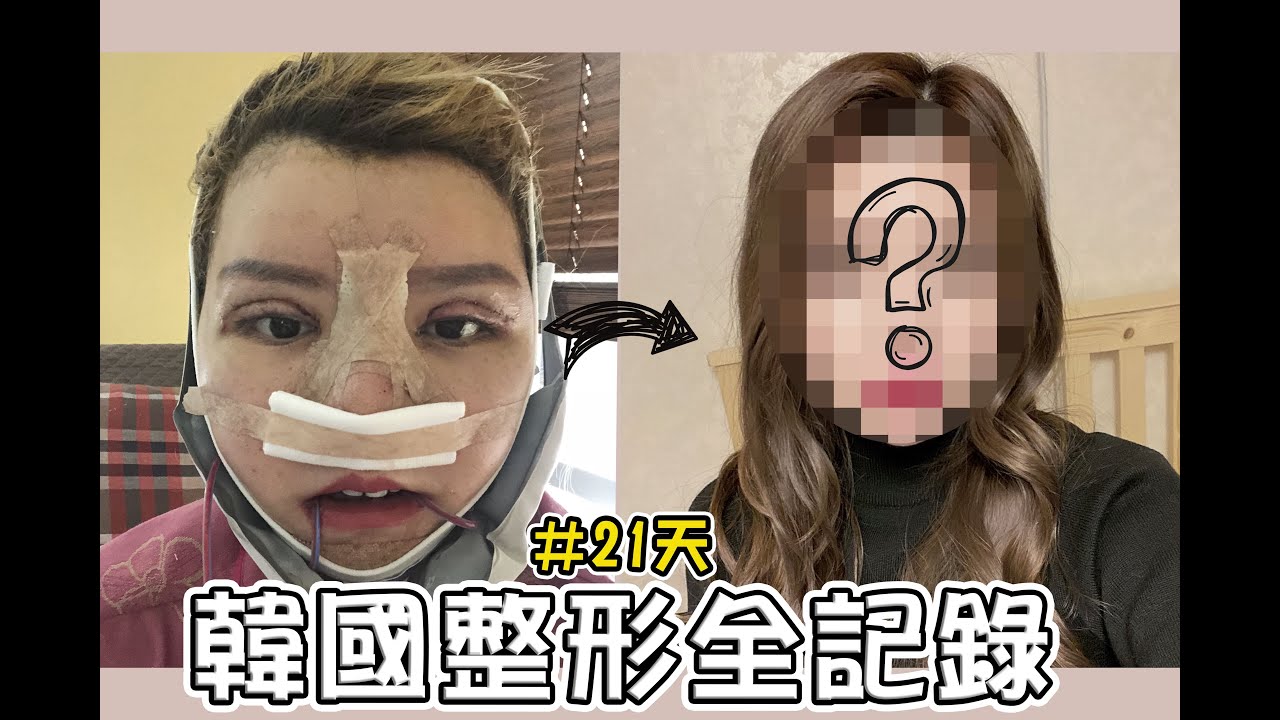 陳妮絲韓國整型全紀錄(削骨+重修眼鼻+下巴取異物)