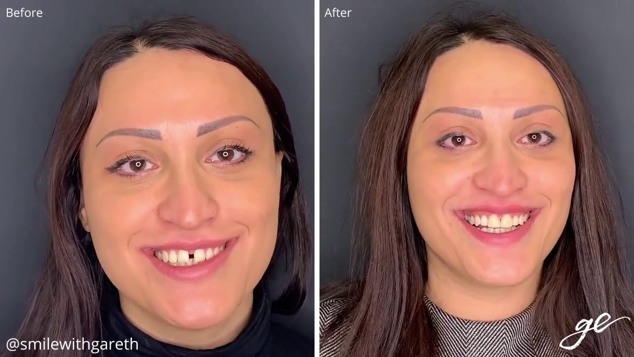 Cosmetic Dental Bonding in Bournemouth