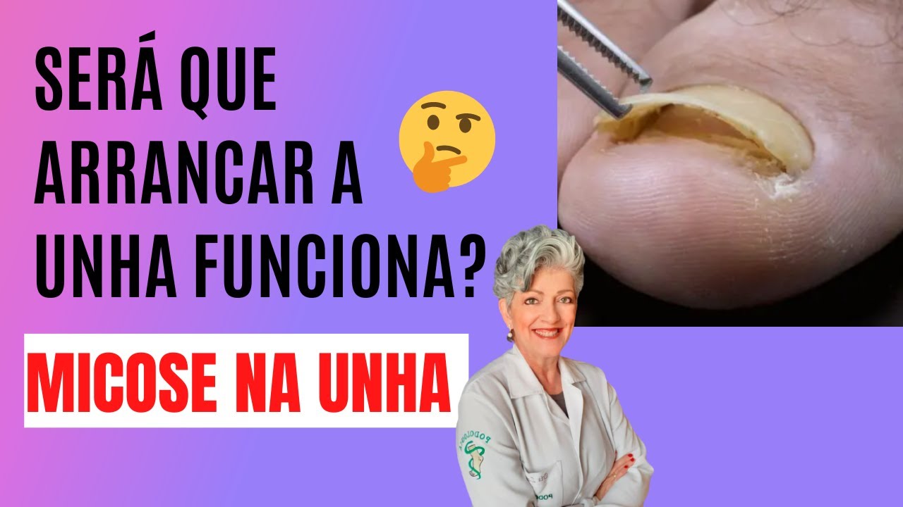 MICOSE DE UNHA Será Que Arrancar a Unha Funciona