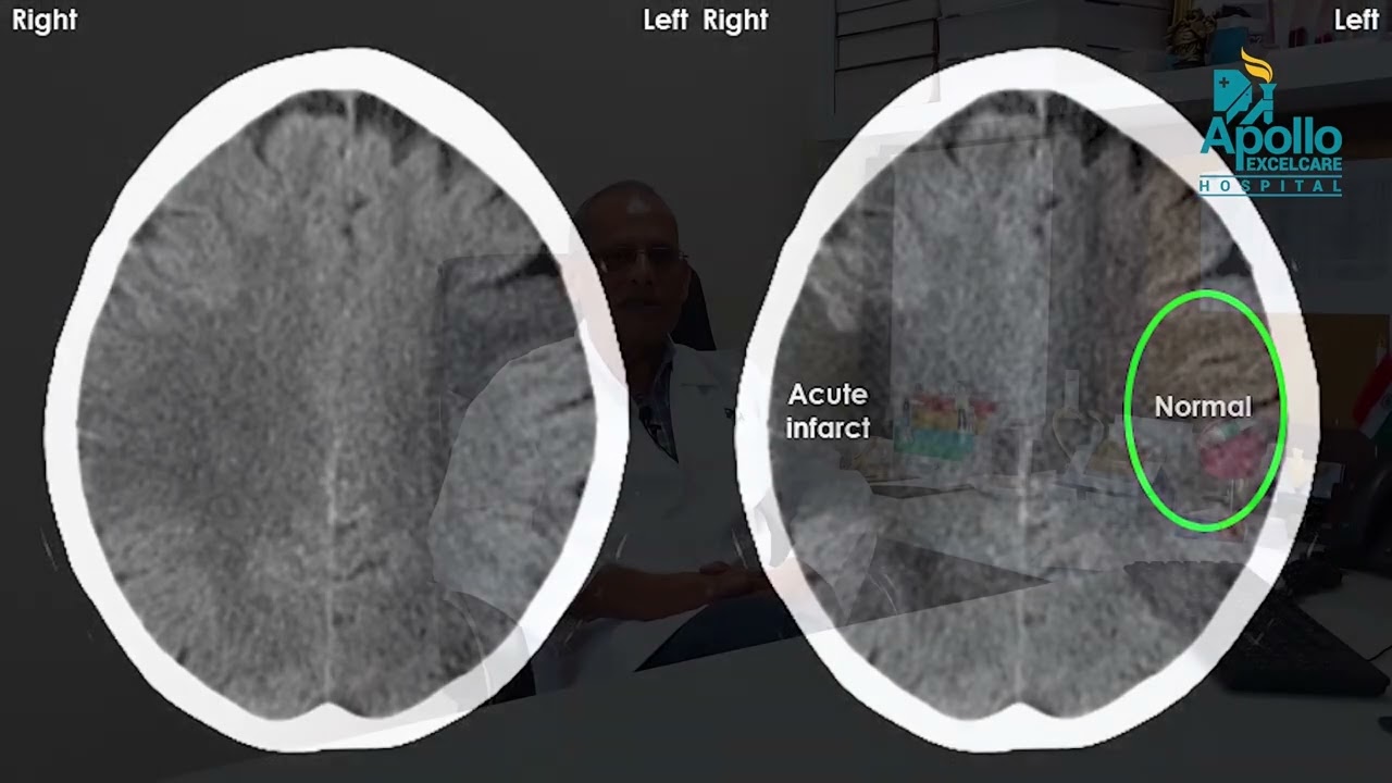 Apollo Excelcare Hospital - A stroke ready hospital with a stroke ready team. #WorldStrokeDay