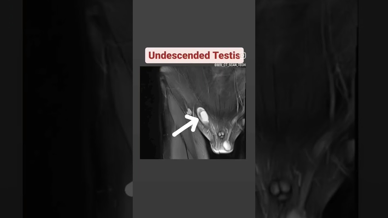 Undescended Testis MRI #shorts #viral #youtubeshorts #mrincredible