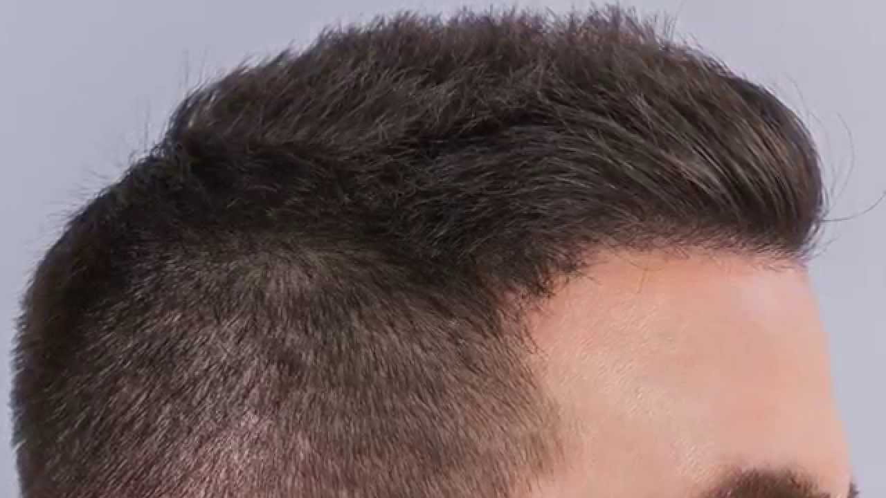 3500 FUE Hair Graft Results &ndash; Dr. Baubac Hayatdavoudi | Los Angeles, CA