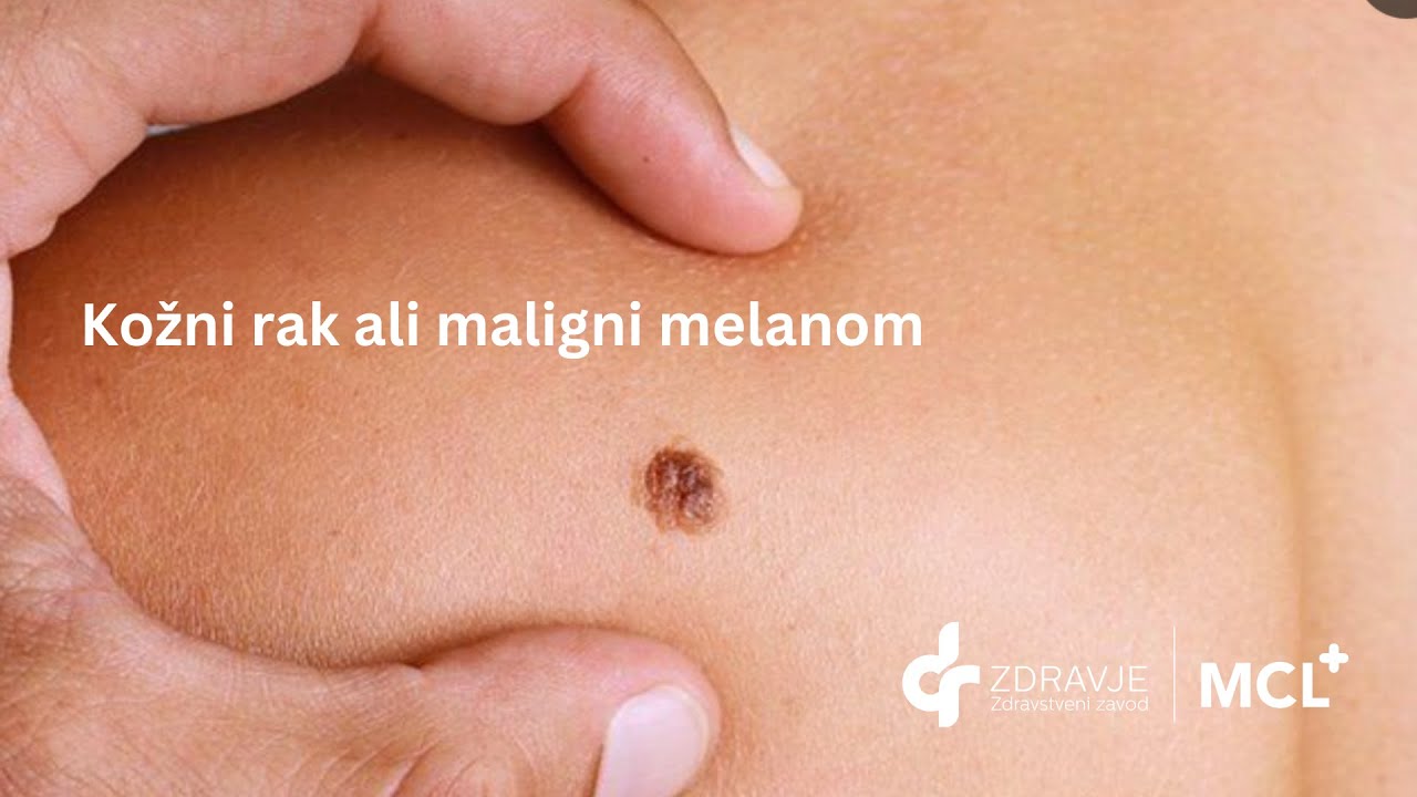 Melanom ali kožni rak - Špela Elizabetha Ulaga, dr. med., specialistka dermatovenerologije