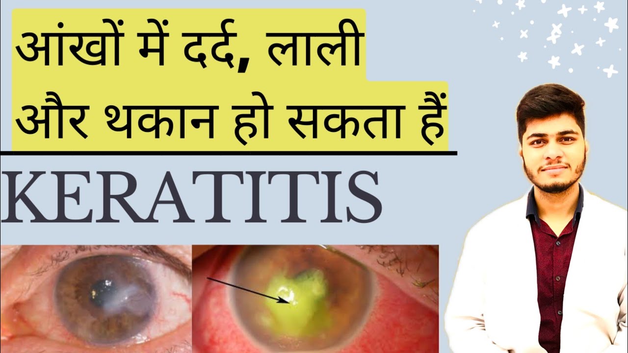 आंखों में दर्द, लाली और थकान हो सकता हैं केराटाइटिस । What cause keratitis in eye । Keratitis