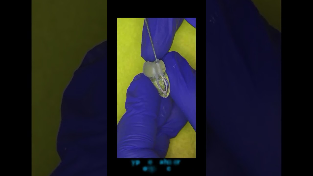 Obturación termoplástica con jeringa GUTTAJECT
