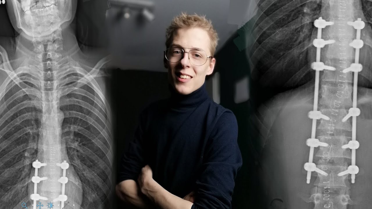 Über meinen Aufenthalt in der Schmerzklinik #Hyperkyphose - Schmerzklinik