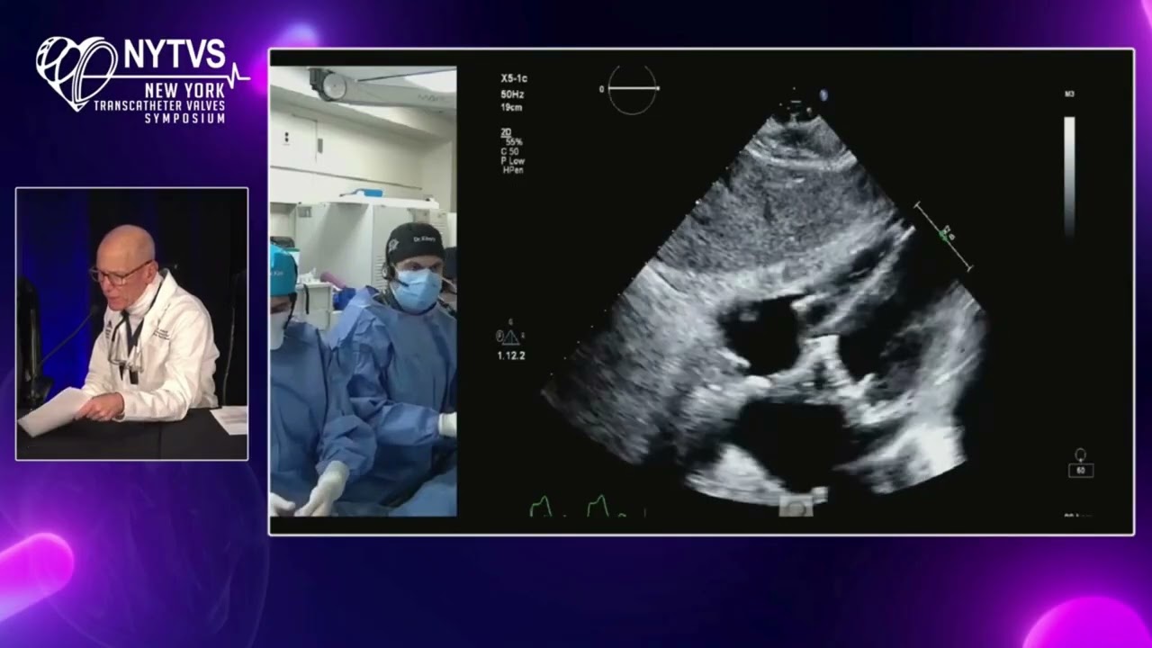 LIVE CASE 6 - TAVR with Severe Annular and LVOT Calcification using NAVITOR Vision