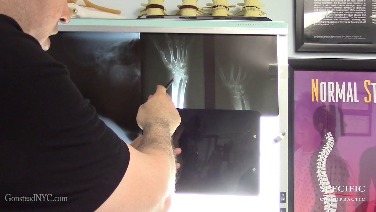 Active Reflex Sympathetic Dystrophy, Complex Regional Pain Syndrome HELPED by Dr Suh