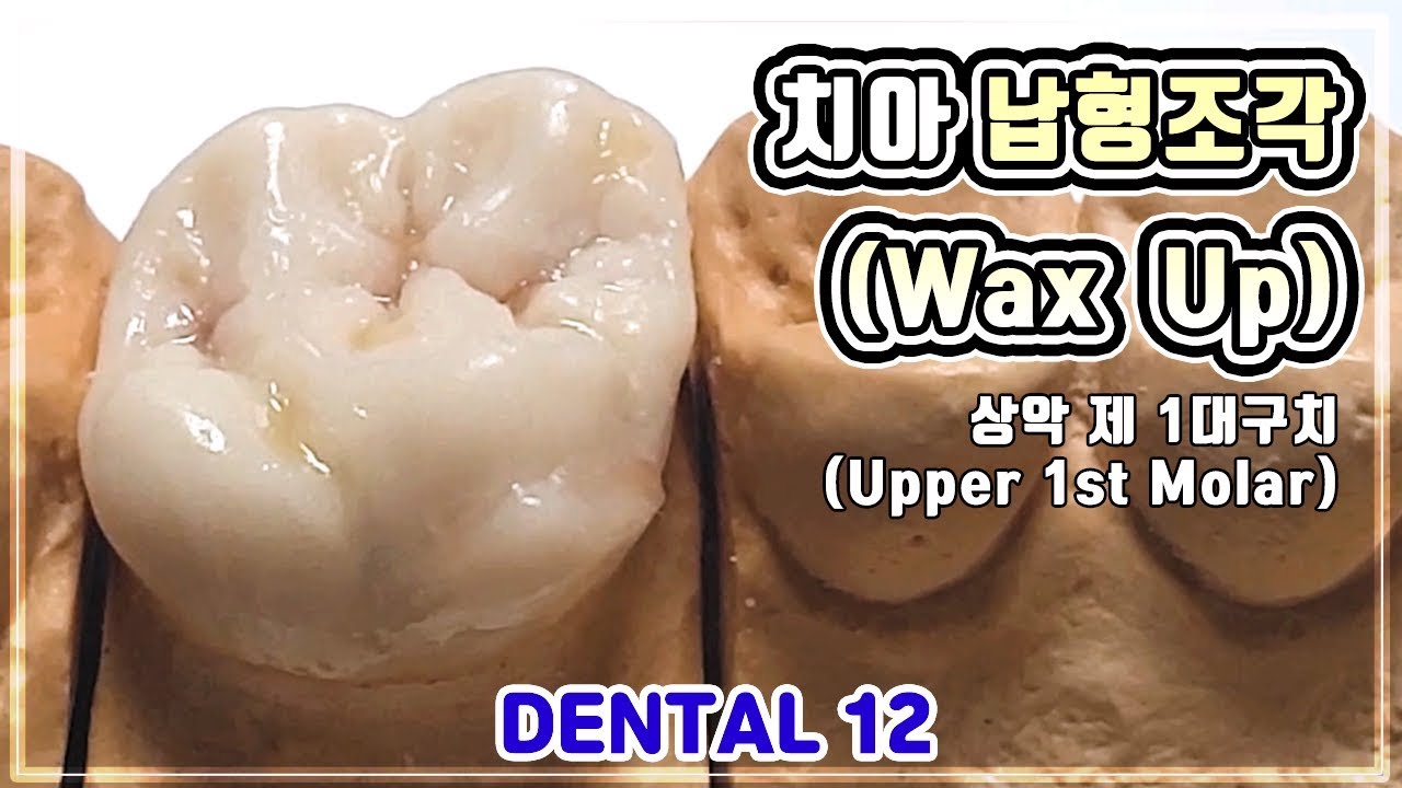 치과 관교의치 상악 제 1대구치 왁스업, wax up (Upper 1st molar wax pattern) [덴티에듀, DentiEDU] [4K]