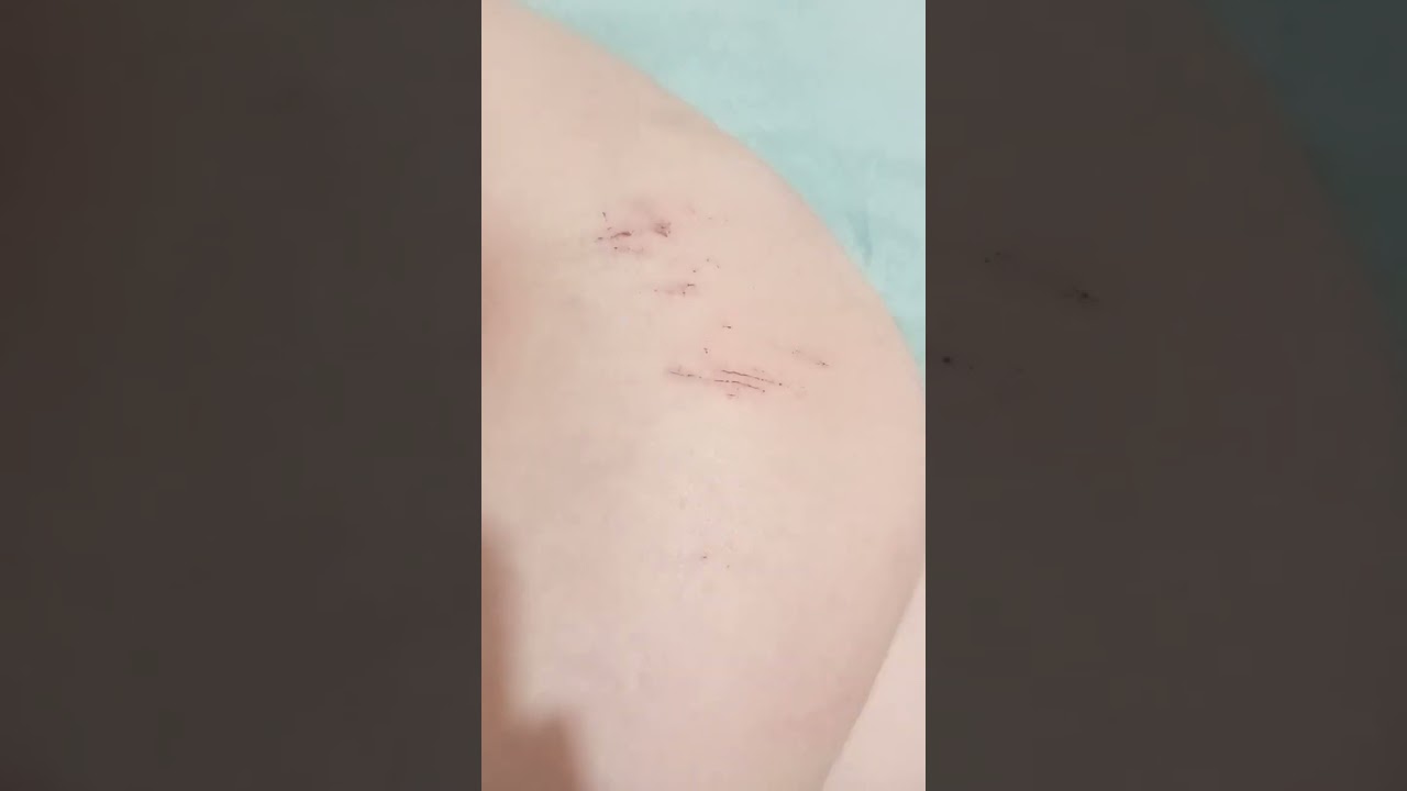 os 2 machucados do dia 24 e 24 que o que tem um bandeid