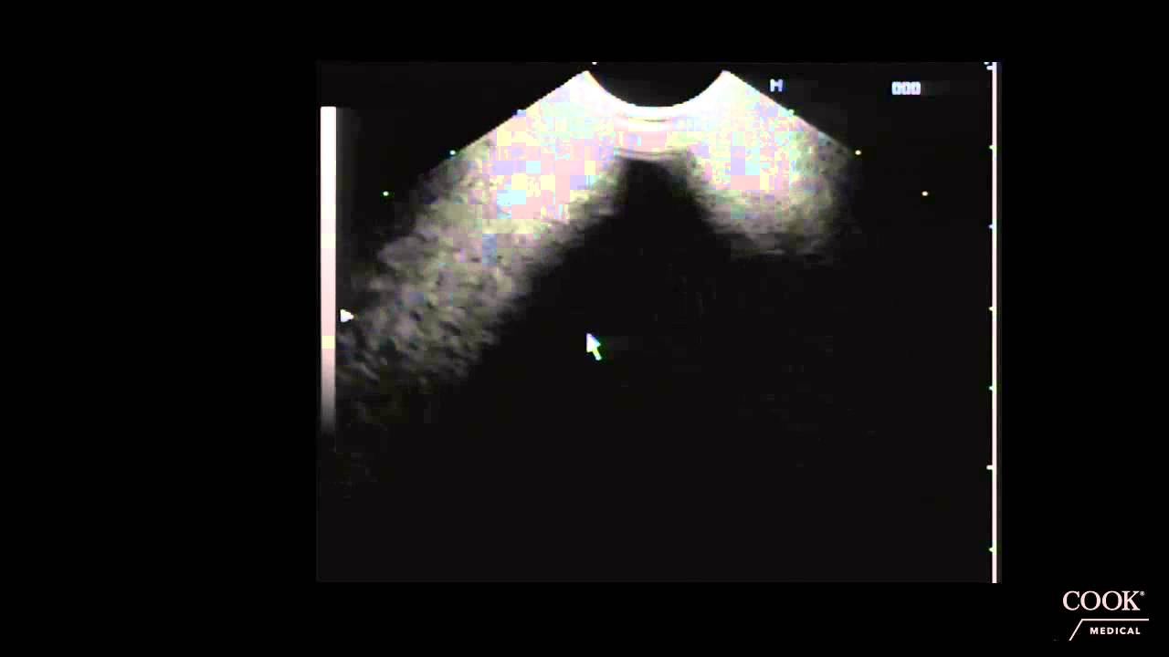 Mediastinal Lymph Node FNA 1 - Dr. Anand Sahai MD