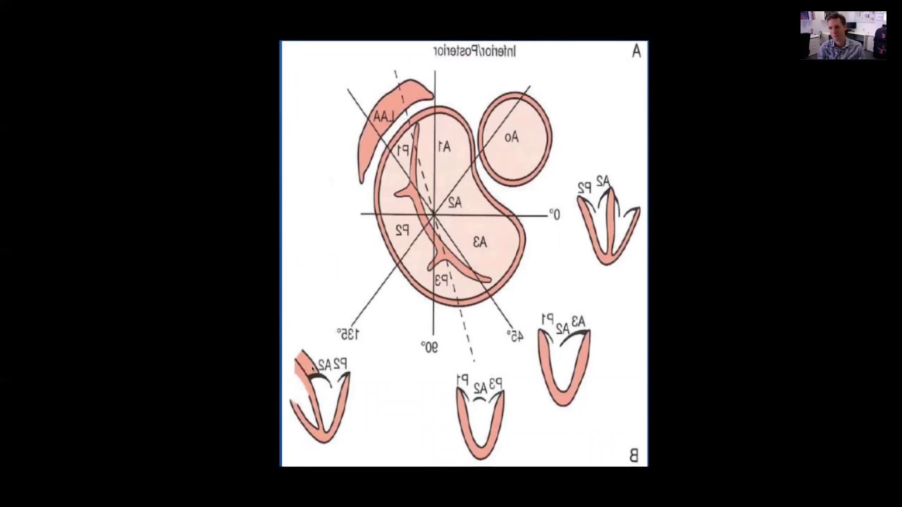 Mitral Regurgitation 1