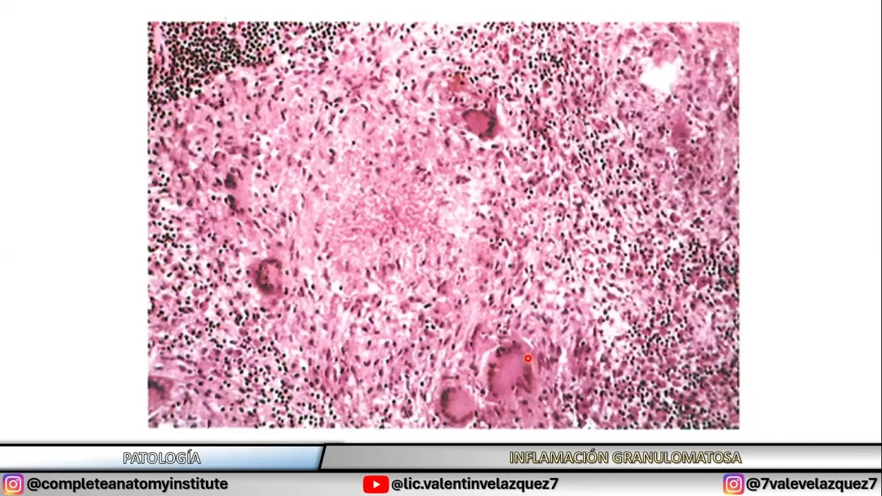 INFLAMACI&Oacute;N GRANULOMATOSA | PATOLOG&Iacute;A
