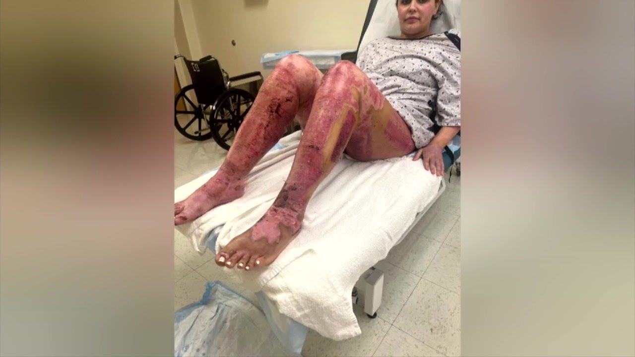 More people sue Miami manufacturer after customers claim tabletop fire pits left severe burns