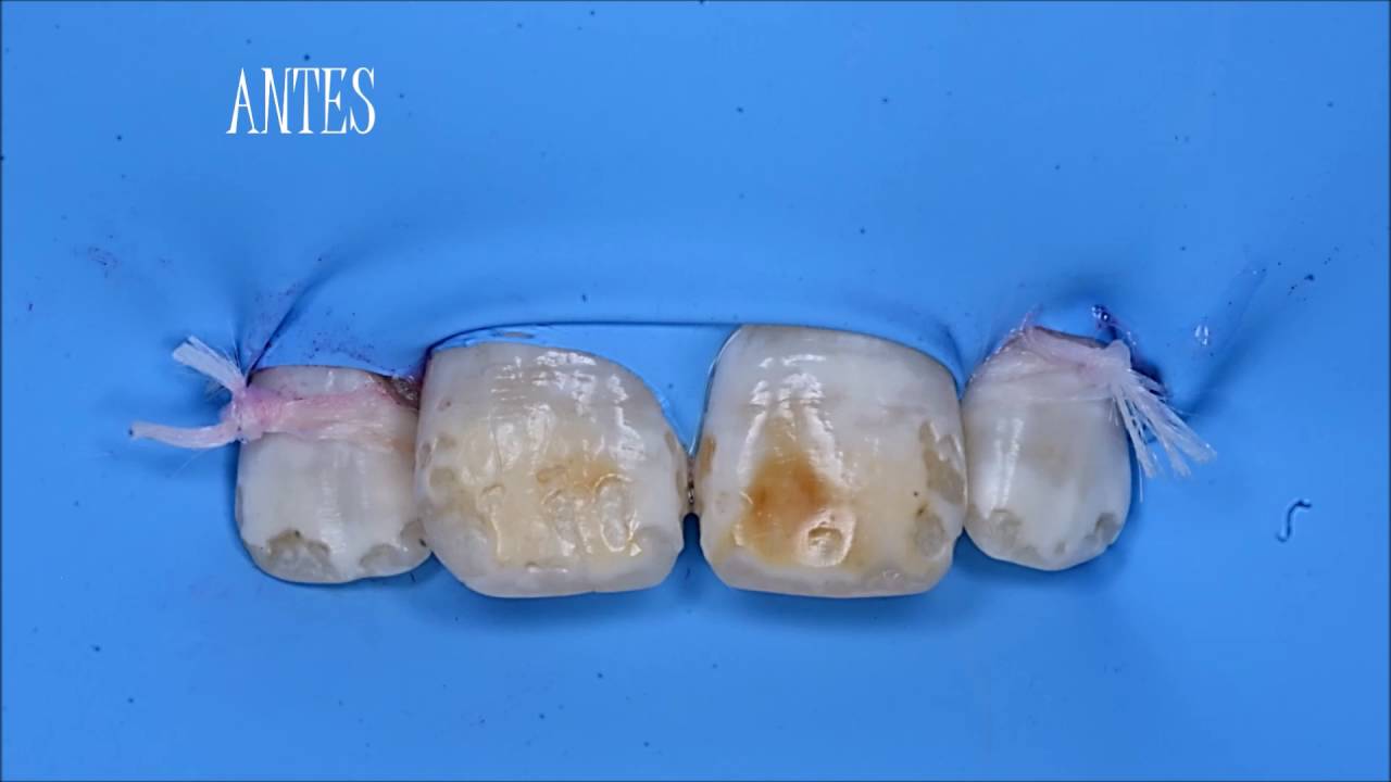 Antivet, técnica sin microabrasión