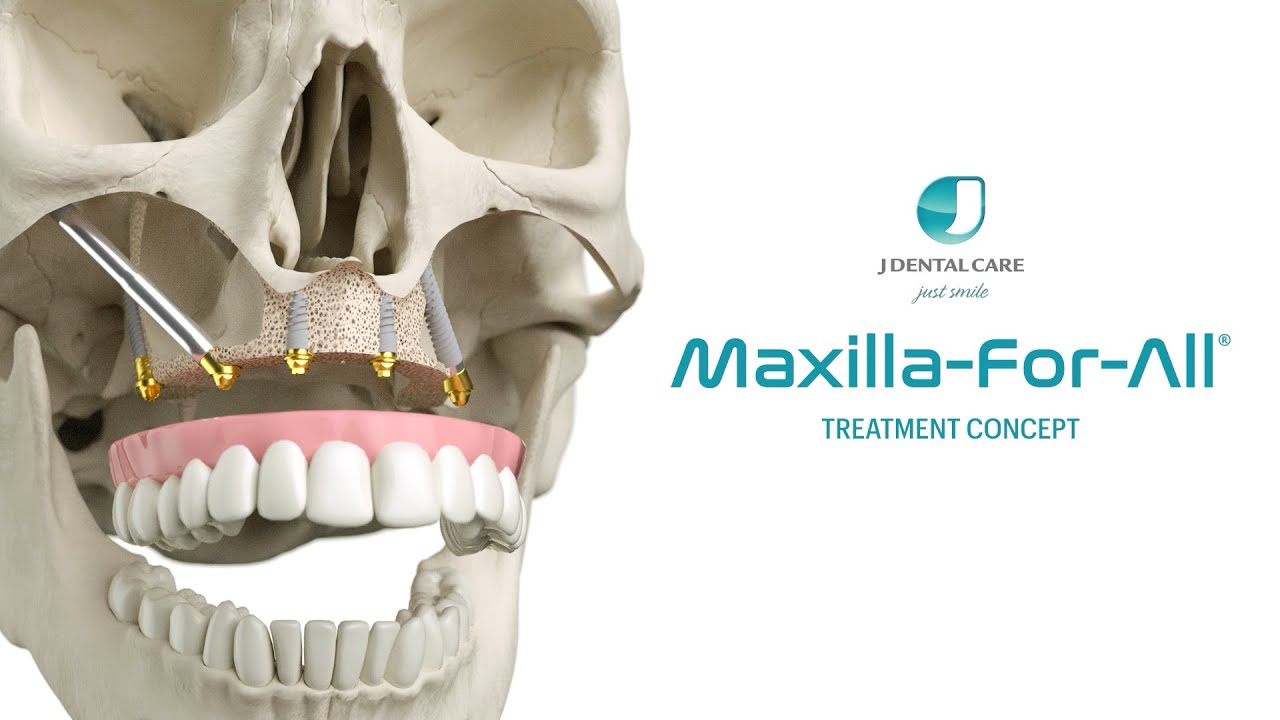 Maxilla-For-All&reg;