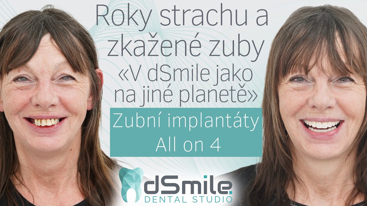 Neuvěřitelná proměna po letech bolesti! All-on-4 implantace v Praze