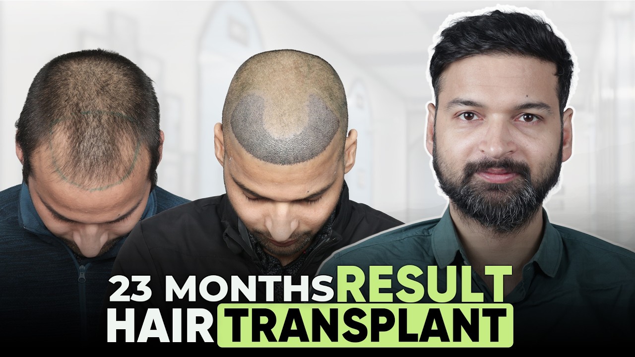 Hair Transplant in Chennai (HX-ERRE) | Best Results & Cost of Hair Transplant in Chennai