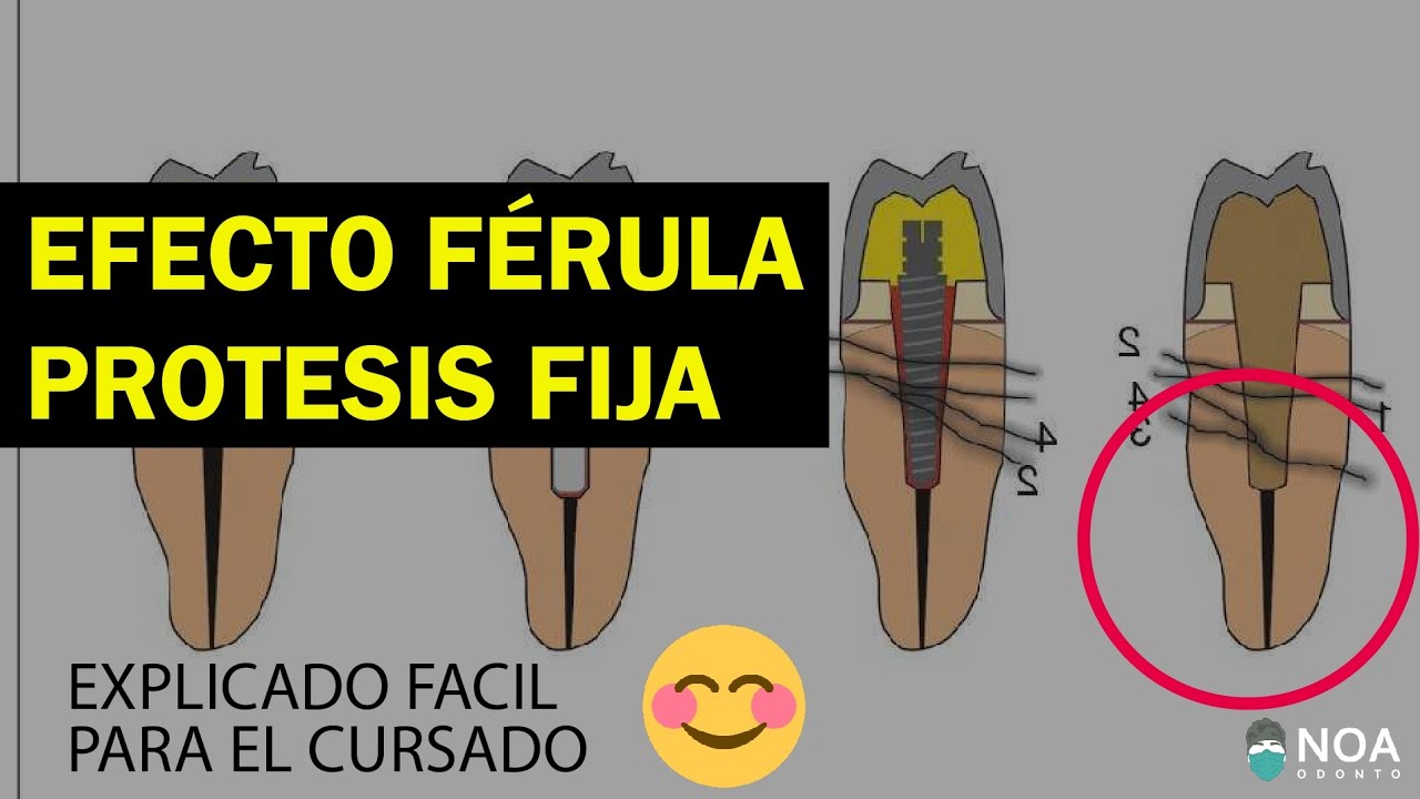 ¿QUE ES EL EFECTO FÉRULA😍 en Prótesis Fija para estudiantes de odontología o Prótesis Dental 🦷❤️