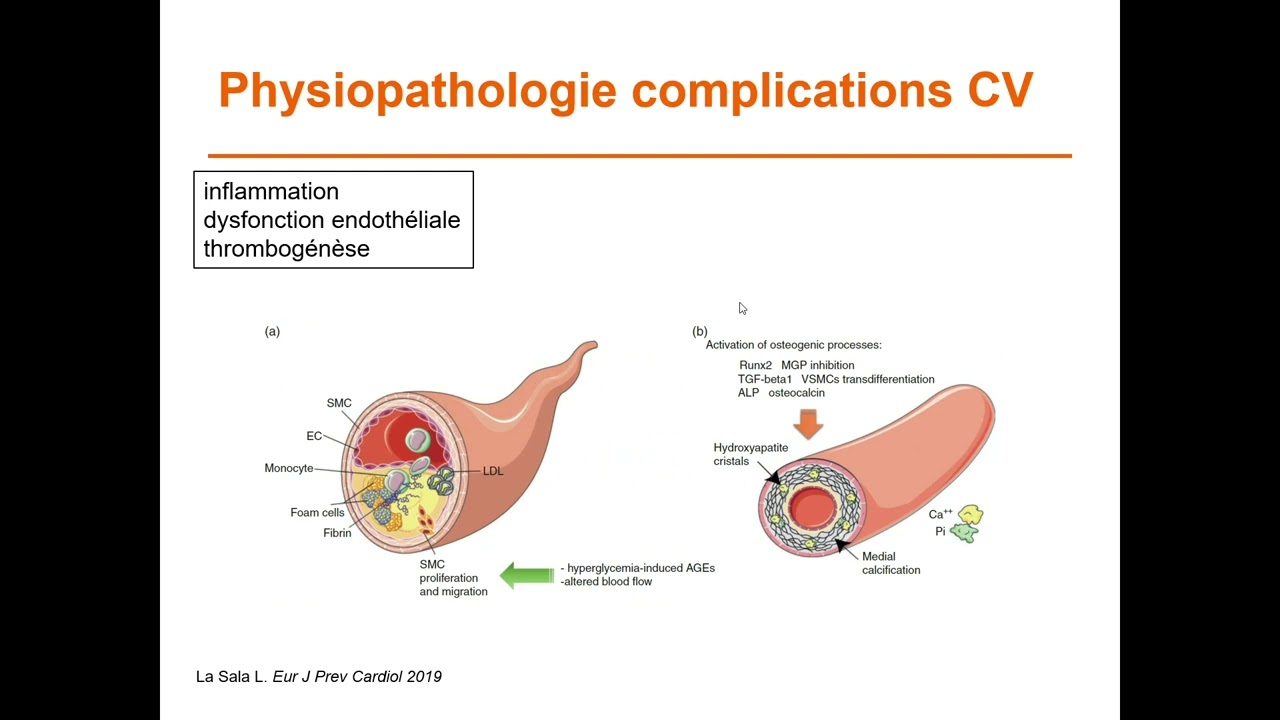 Risque cardiovasculaire à l’effortdiabète de type 1