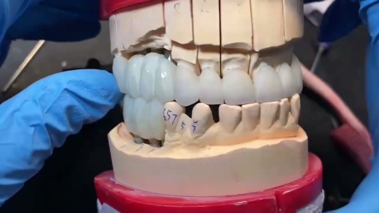 BruxZir Crowns In The Making