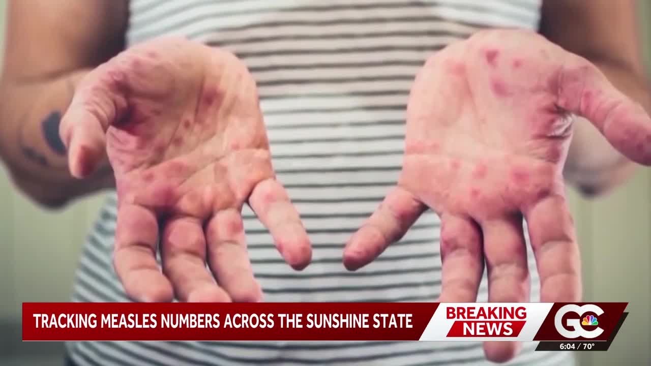 Measles cases continue to rise in Collier County: 78 confirmed, 15 probable