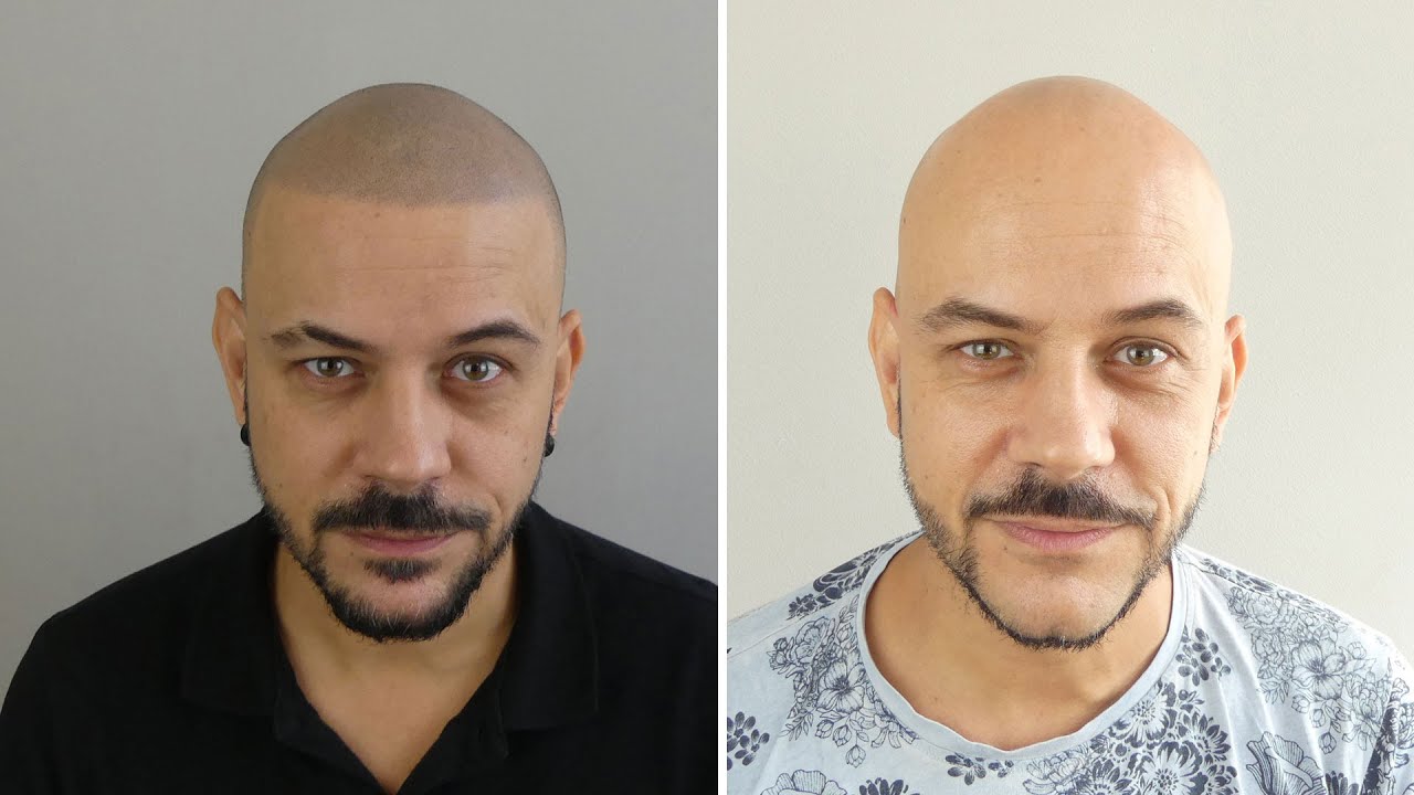 Micropigmentation Cheveux à Toulouse Pour un Look Stylé Naturel