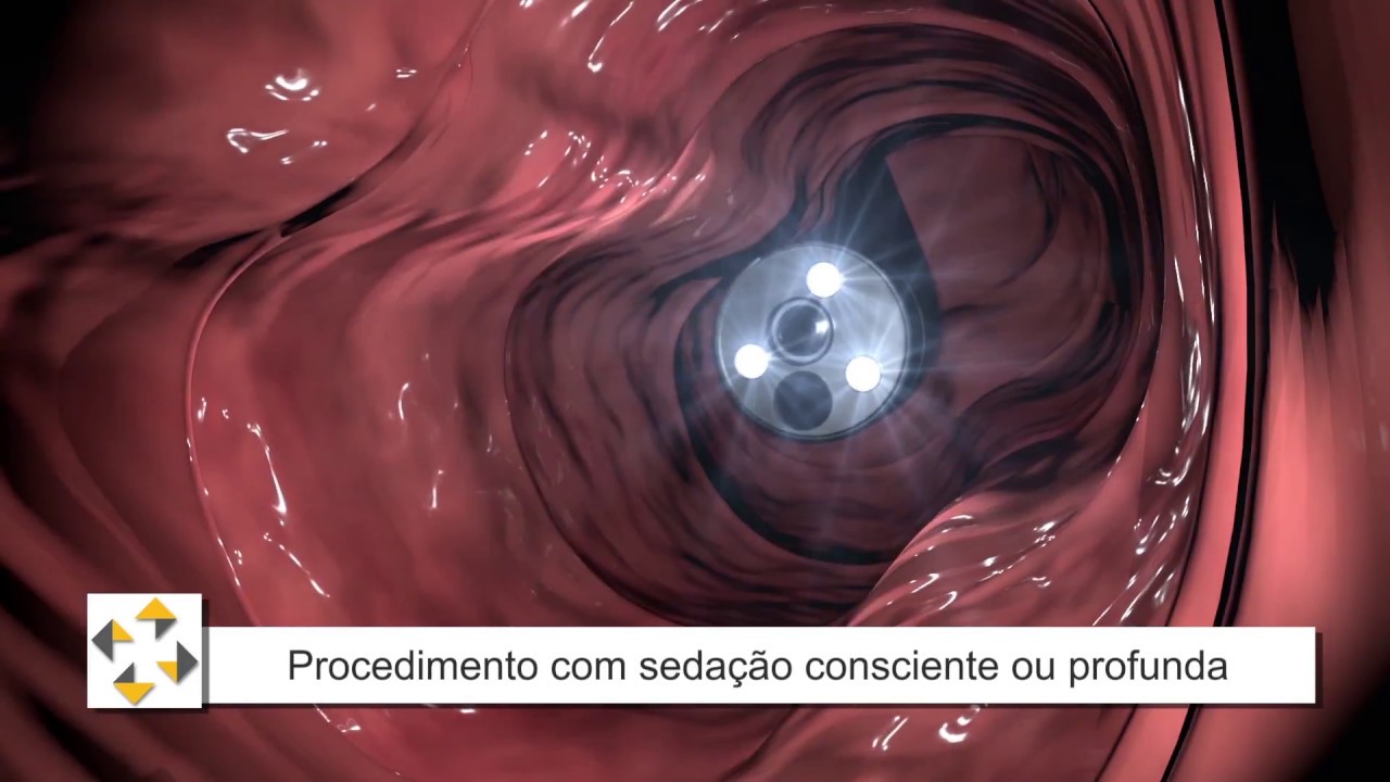 Como &eacute; o exame de colonoscopia?